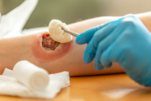  LA PREVENZIONE ED IL TRATTAMENTO DELLE LESIONI DA PRESSIONE